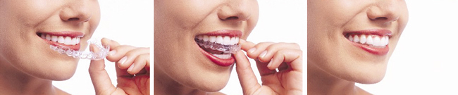invisalign