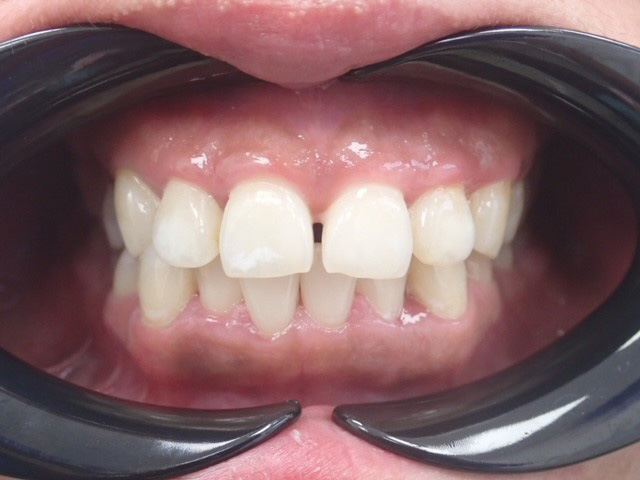 Before